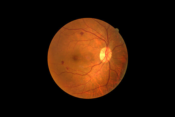 Diabetic Eye Scan