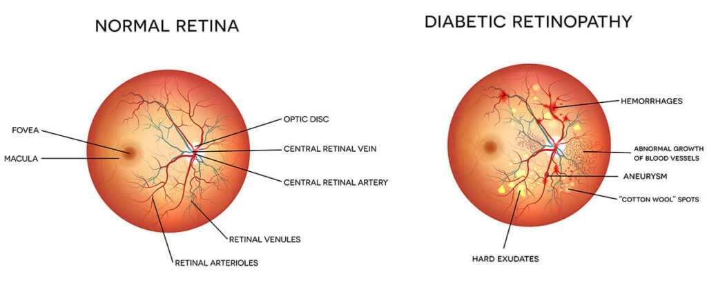 Chart Illustrating the difference between a normal retina and one with diabetic retinopathy