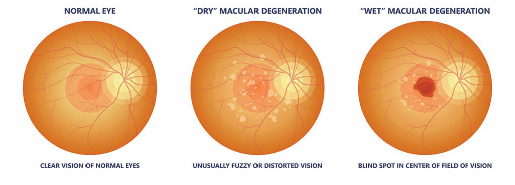 Chart Illustrating the Difference Between Wert and Dry Macular Degeneration