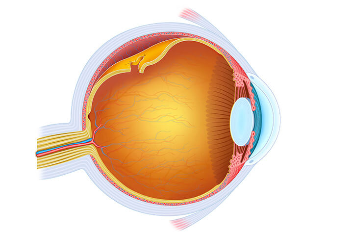 Chart Illustrating a Retinal Detachment in an Eye